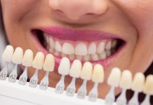 Você conhece os benefícios das Facetas Dentárias?