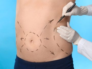 Quais os principais cuidados no pós-operatório abdominoplastia